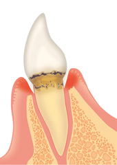 歯周病の進行状況と治療