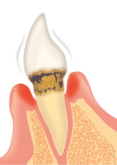 歯周病の進行状況と治療